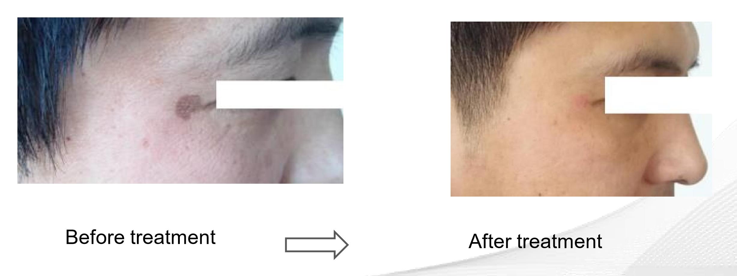Pico Laser – Công nghệ xoá sắc tố, trị nám, làm sáng da